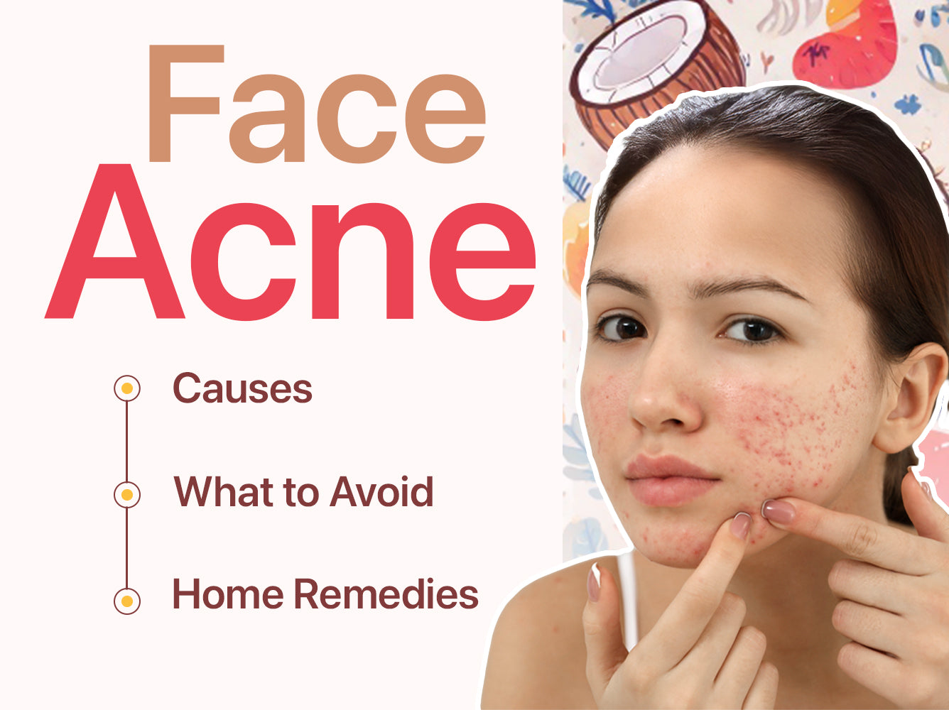 Face Acne: Causes, What to Avoid & Home Remedies