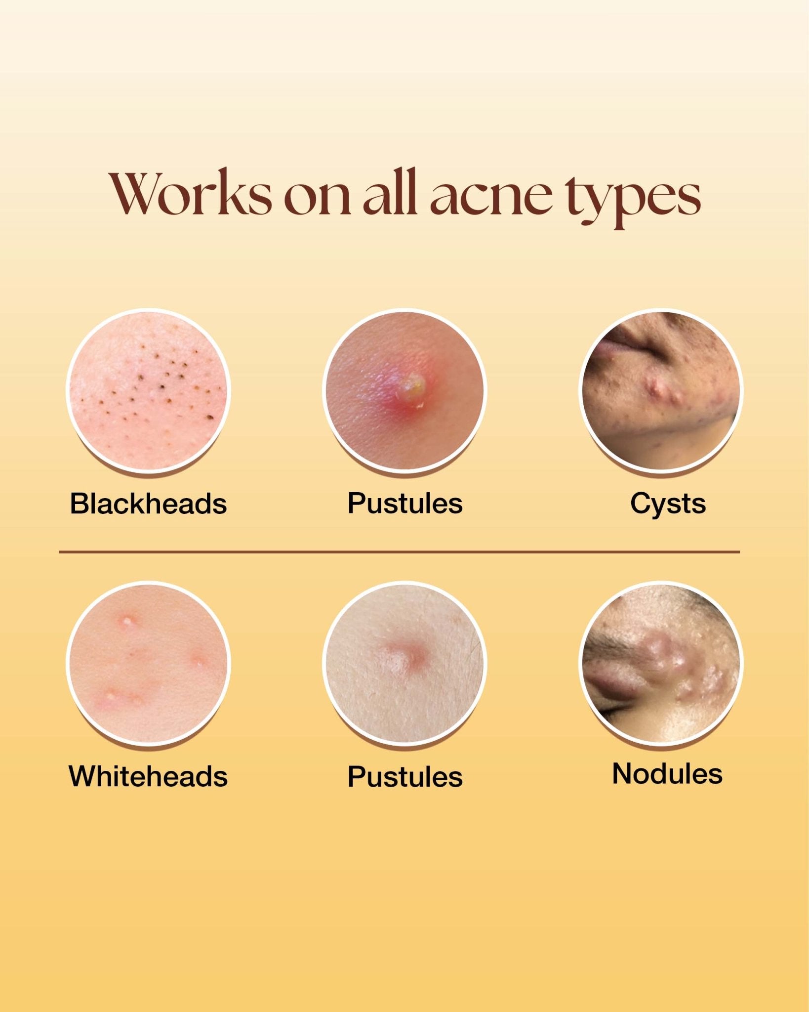 Acne Spot Corrector Gel - Siya Ayurveda
