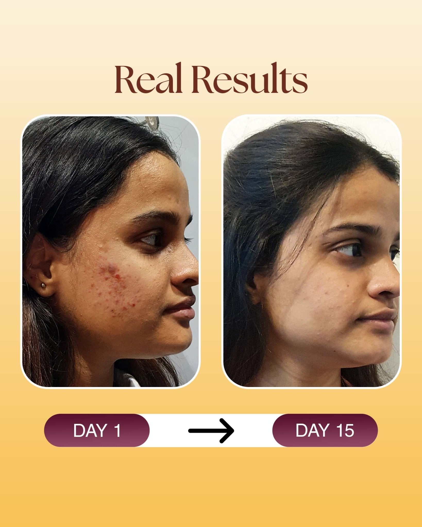 Acne Spot Corrector Gel - Siya Ayurveda