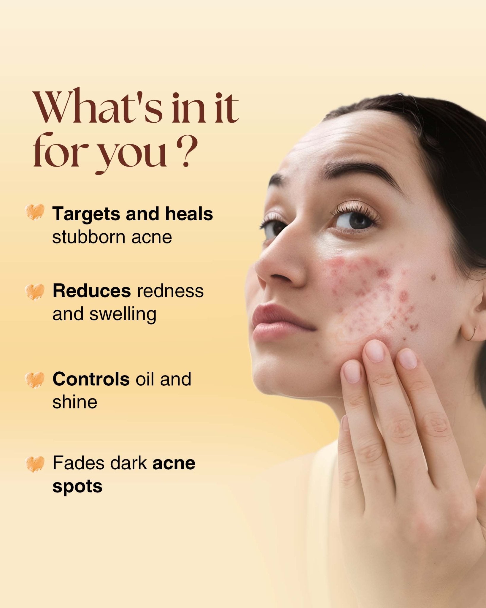Acne Spot Corrector Gel - Siya Ayurveda