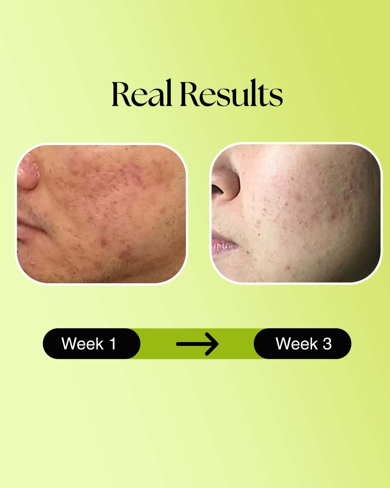 Anti Acne Face Wash: Foaming Face wash - Siya Ayurveda