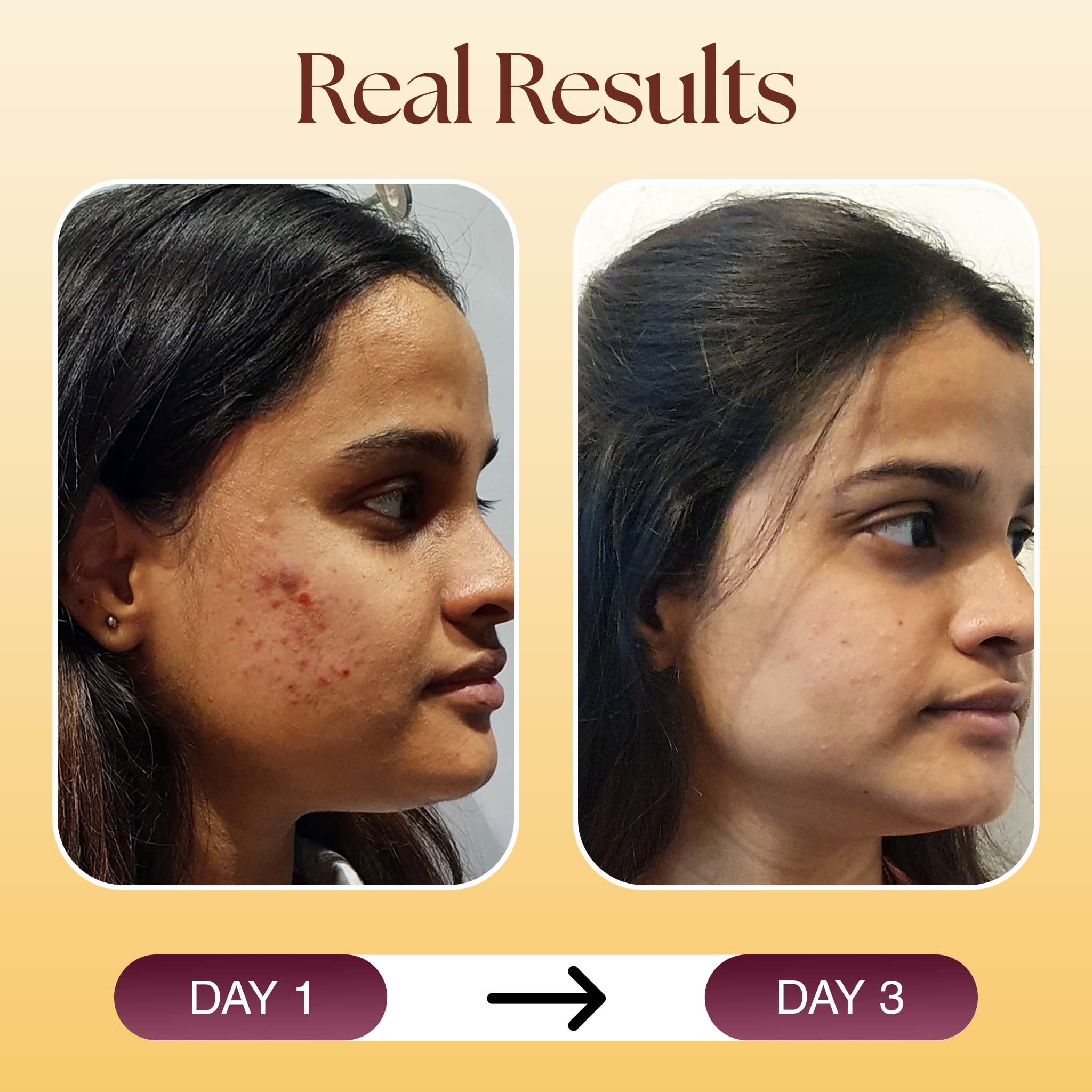 Anti Acne Kit with Powerful Benefits of Niacinamide and Azelaic Acid - Siya Ayurveda