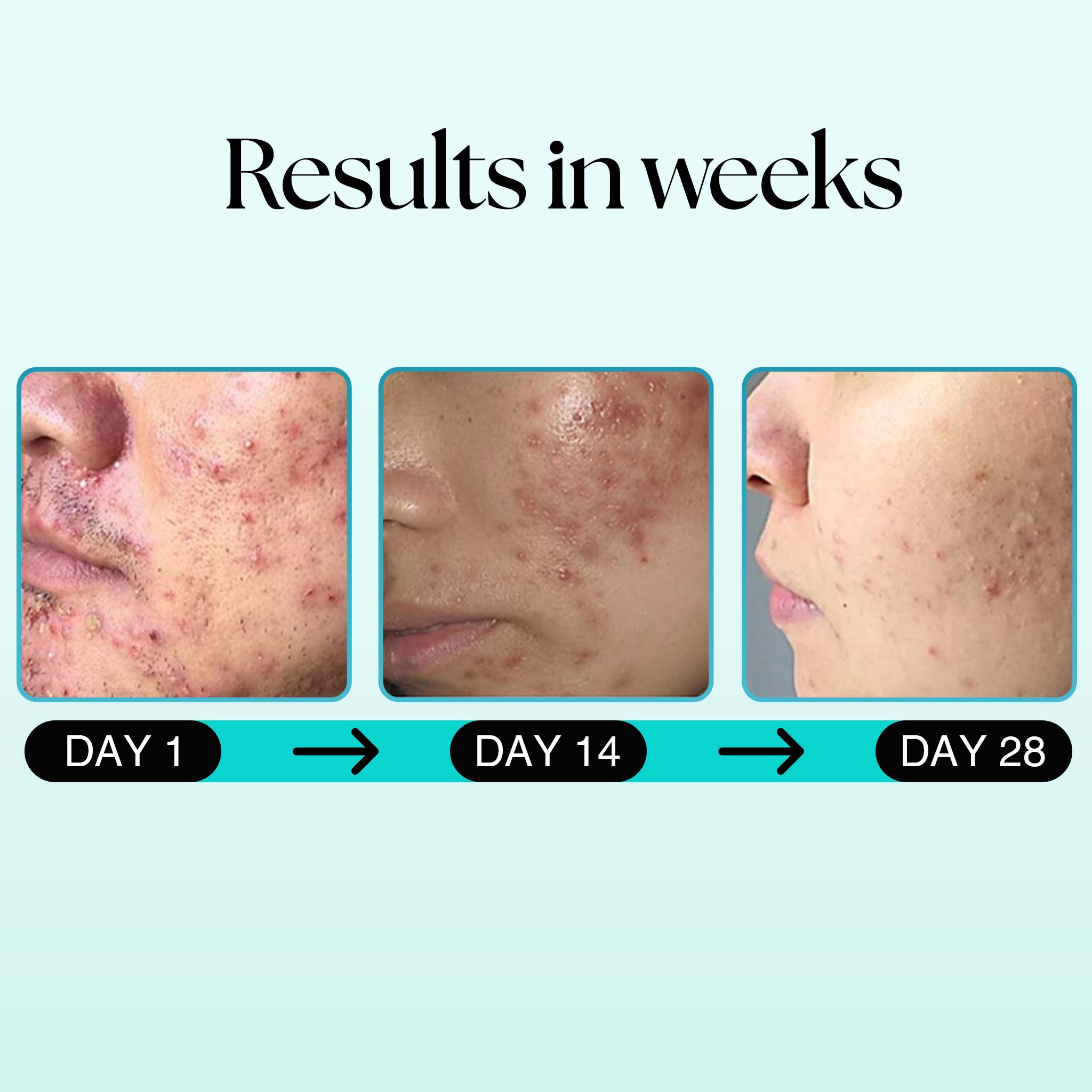 Daily Glow Kit (Salicylic Acid Face Wash + Niacinamide Gel Cream with Tea Tree Oil) - Siya Ayurveda