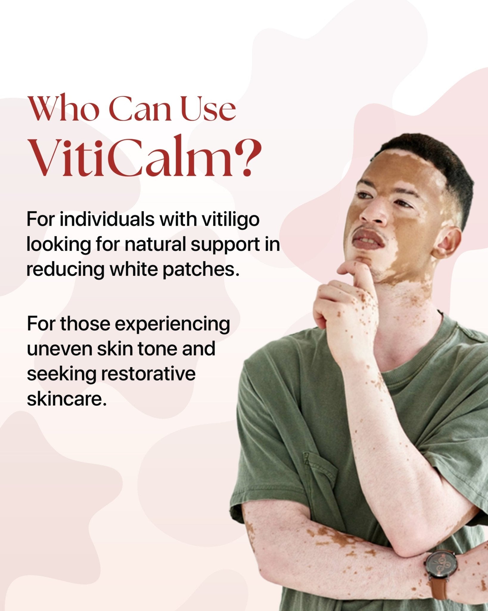 VitiCalm : Cream for Vitiligo | Vitiligo Treatment Solution - Siya Ayurveda