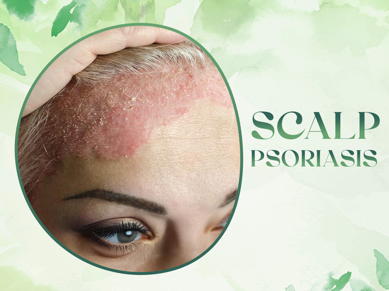 Understanding Scalp Psoriasis: Causes, Symptoms, and Treatment Options