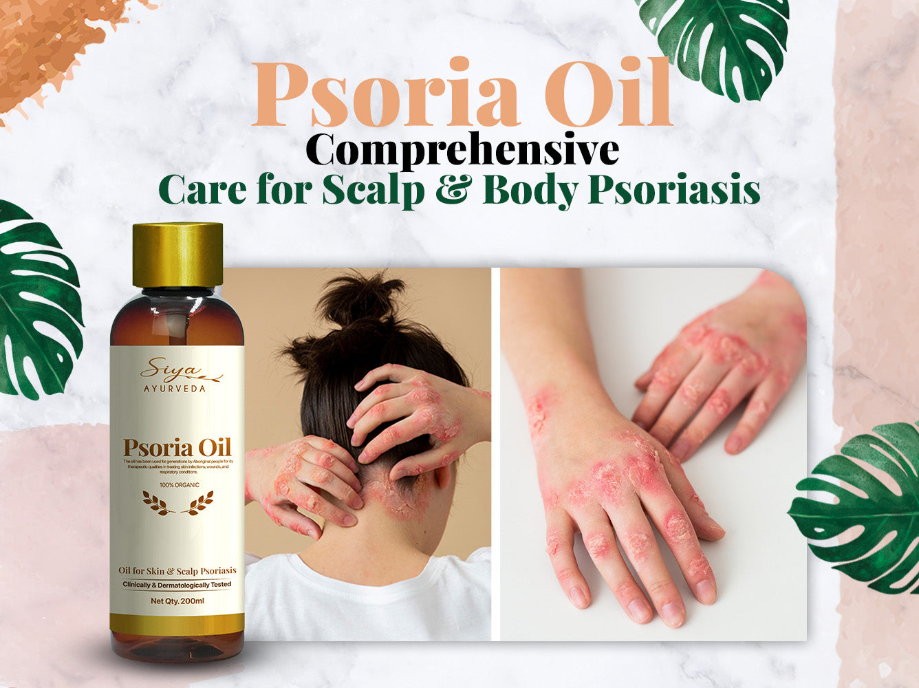 Psoria Oil Comprehensive Care for Scalp & Body Psoriasis