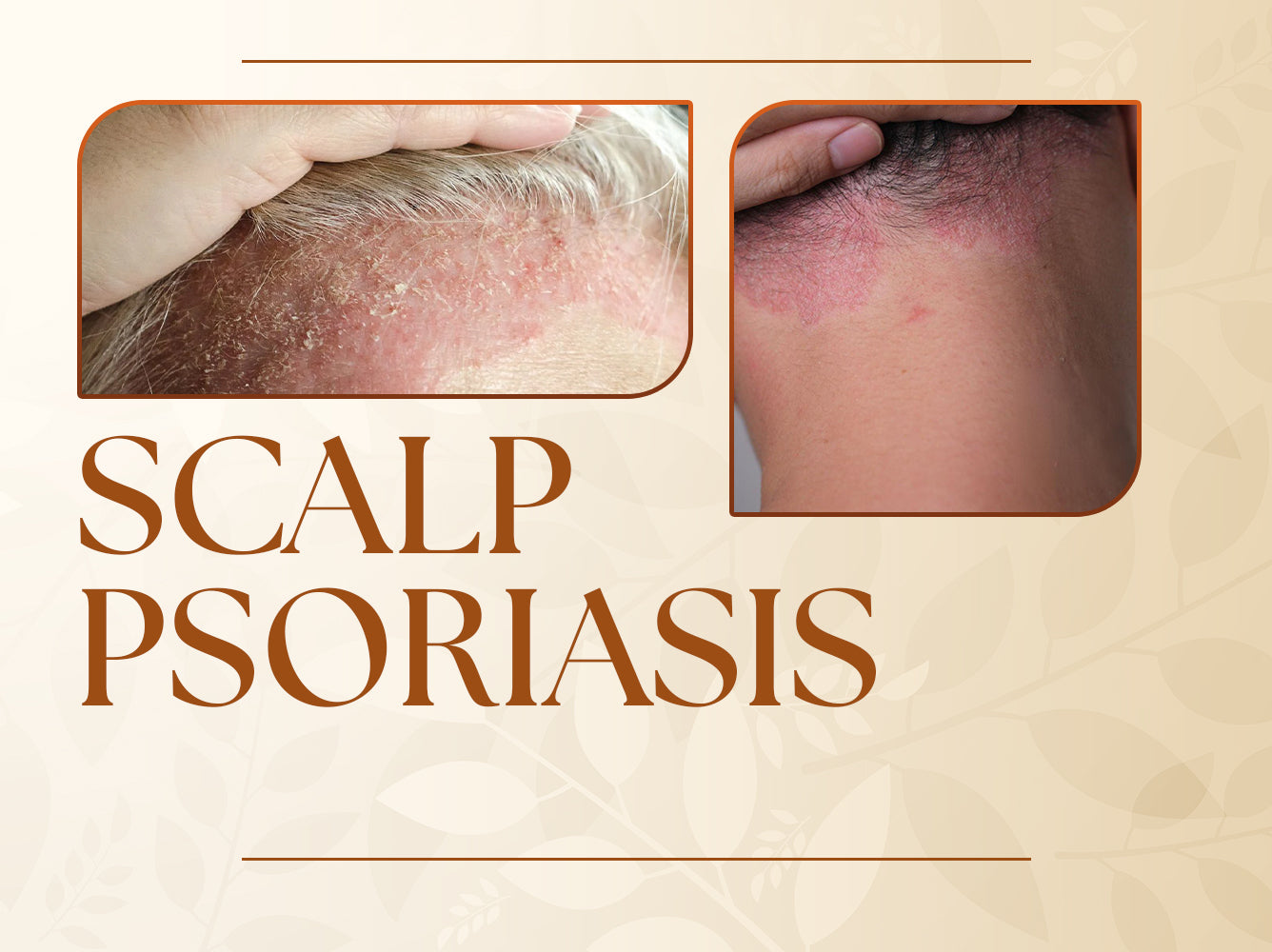 How Does Scalp Psoriasis Impact Your Body?