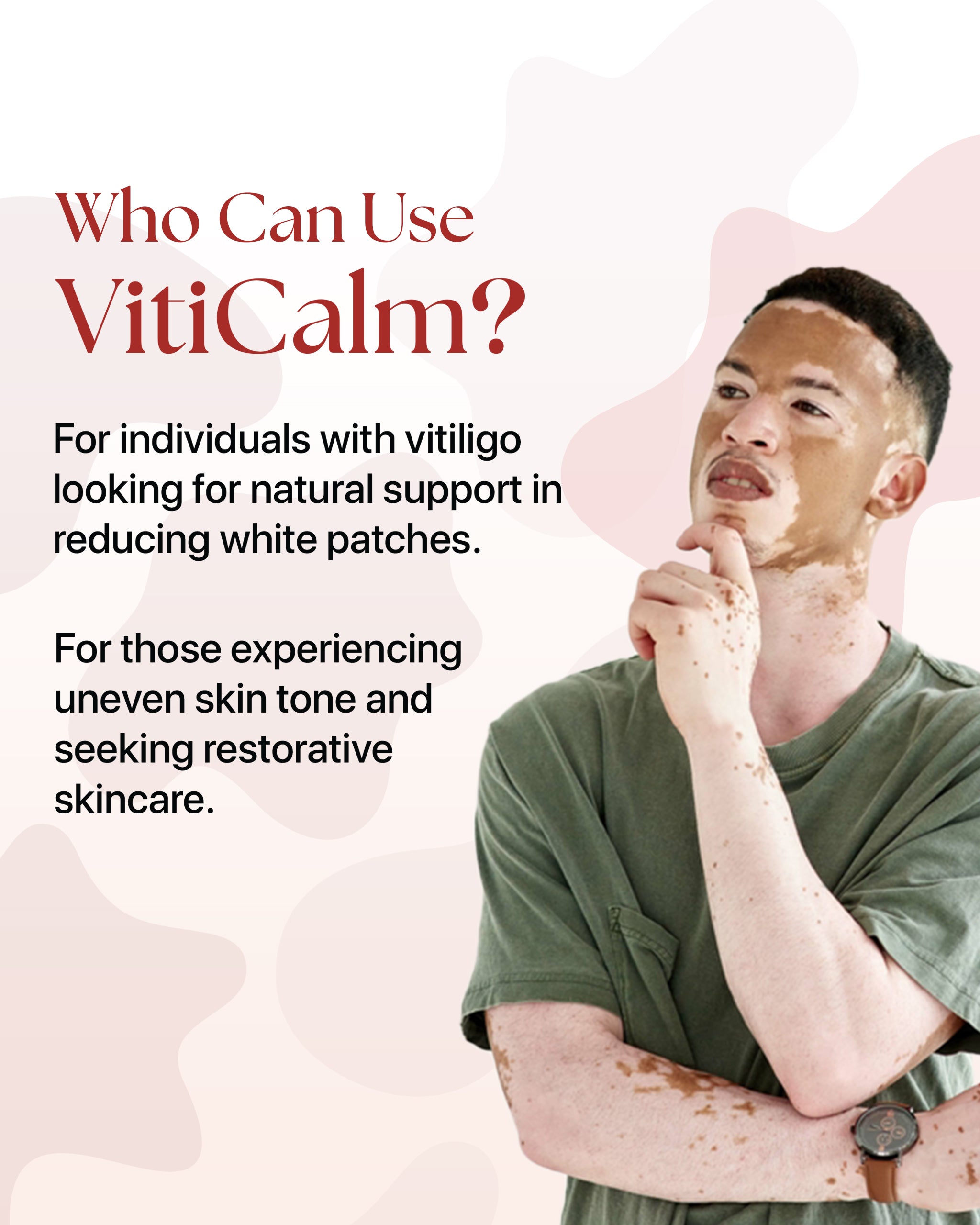 VitiCalm : Cream for Vitiligo | Vitiligo Treatment Solution