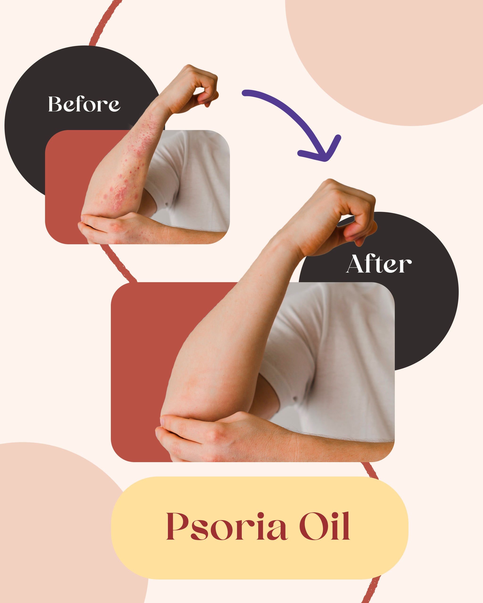 Psoria Oil: Oil for Scalp and Full Body Psoriasis